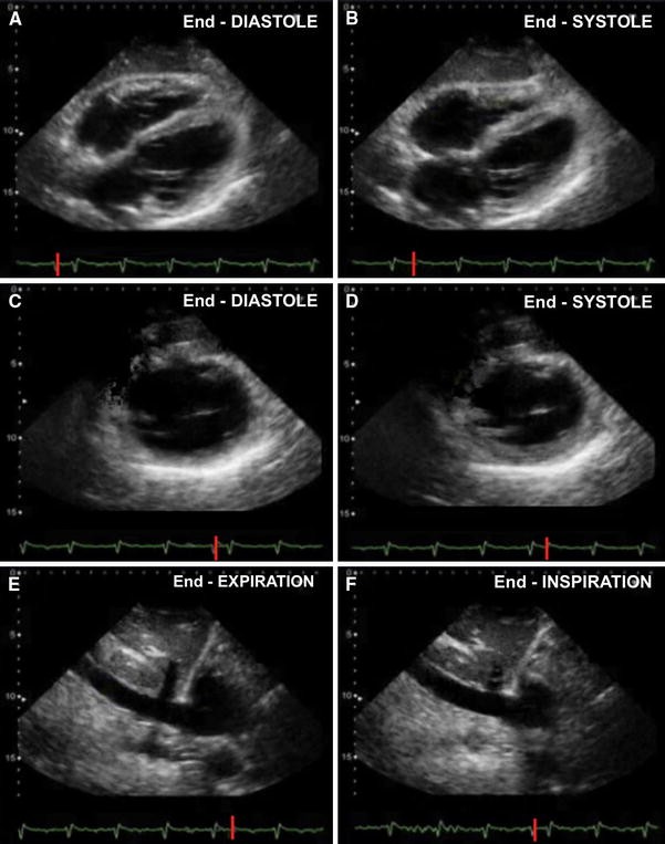 Echocardiography in the sepsis syndromes The Ultrasound Journal Full Text