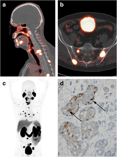 68Ga-PSMA PET-CT Imaging of Metastatic Adenoid Cystic Carcinoma ...