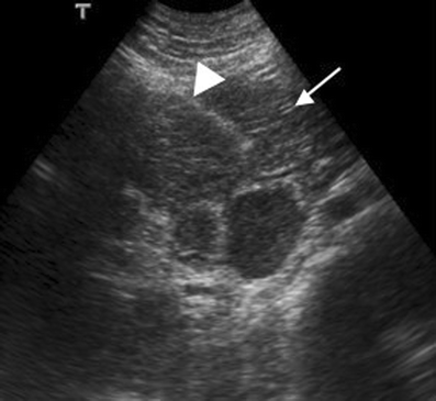 Imaging of pancreas transplantation and its complications | Insights ...