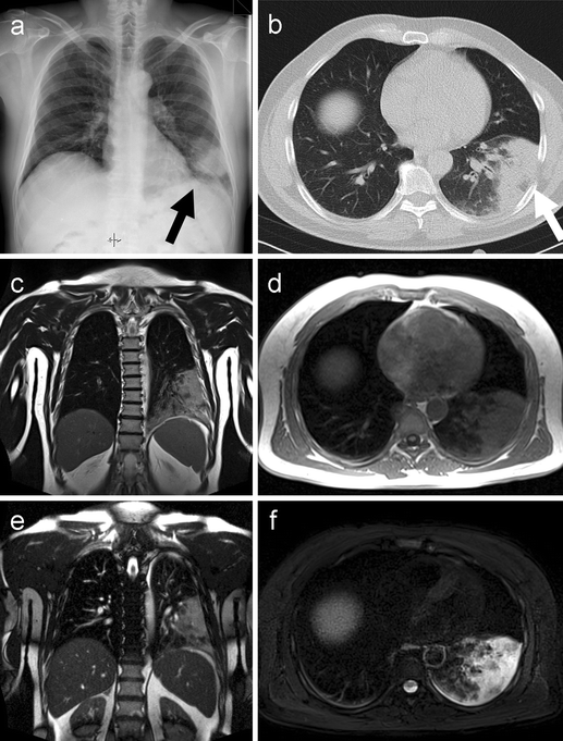 MRI of the lung (2/3). Why … when … how? SpringerLink