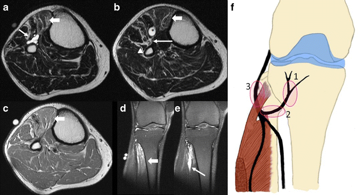 Peroneal Nerve Normal Anatomy And Pathologic Findings On Routine Mri