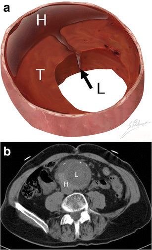 Rupture signs on computed tomography, treatment, and outcome of abdominal aortic aneurysms ...