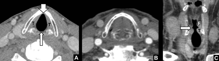 Vocal cord paralysis: anatomy, imaging and pathology | SpringerLink