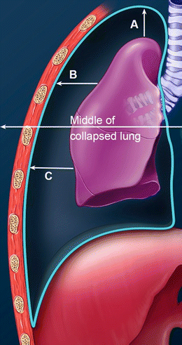 Demystifying the persistent pneumothorax: role of imaging ...