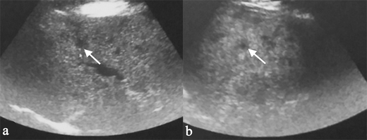 Foundation for sarcoidosis patient registry picture