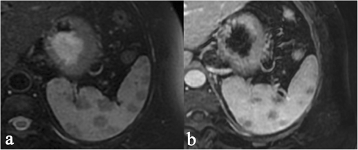 Sarcoidosis patient handout picture