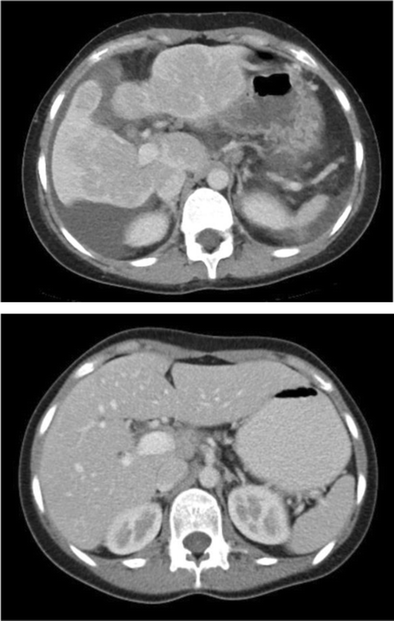 Causes of hepatic capsular retraction: a pictorial essay | Insights ...