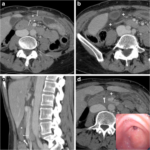 Nonperforated peptic ulcer disease multidetector CT findings