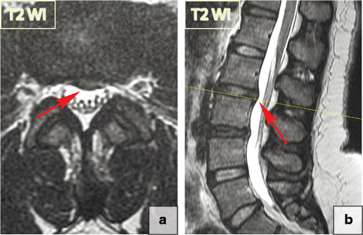 ABCs of the degenerative spine Insights into Imaging Full Text