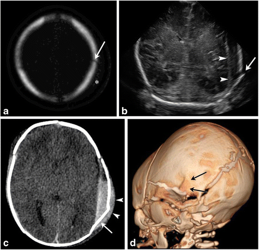 Mechanical birth-related trauma to the neonate: An imaging perspective ...