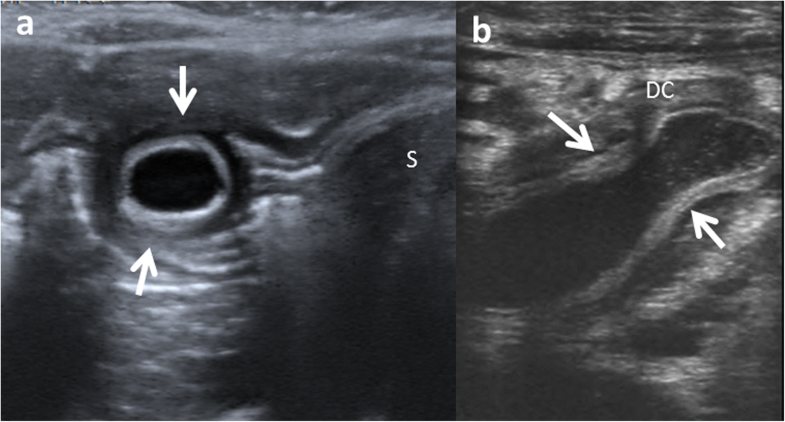 Enteric duplication cysts in children: varied presentations, varied ...