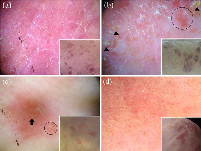 Dermoscopy in General Dermatology: A Practical Overview | SpringerLink