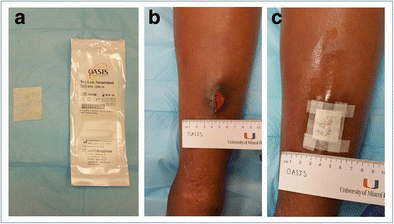 Wound Dressings: A Comprehensive Review | SpringerLink