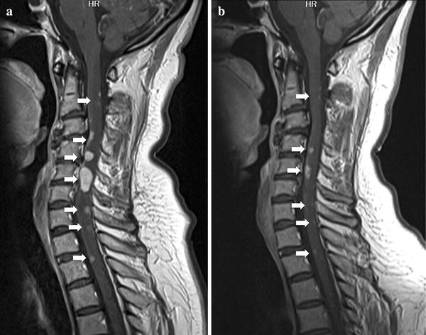 Marked improvement in leptomeningeal carcinomatosis and spinal cord ...