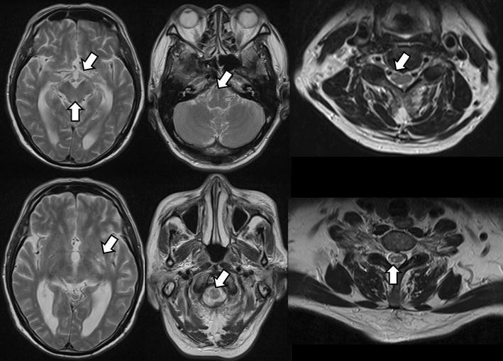 Hyponatremia associated with demyelinating disease of the nervous ...