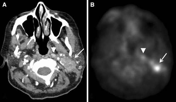 Radiologic Assessment of Lymph Nodes in Oncologic Patients | SpringerLink