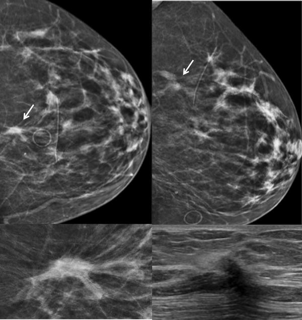 bi rads category 02 benign finding 2a