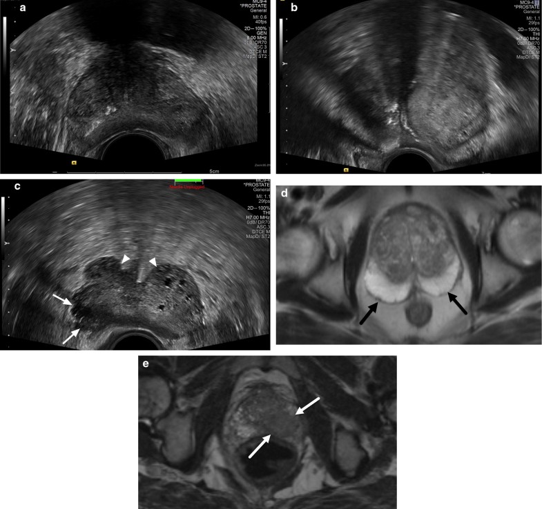 Prostate Cancer Detection and Diagnosis: Role of Ultrasound with MRI