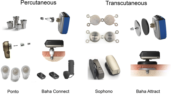 Implantable Hearing Devices | SpringerLink