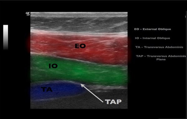 Transversus Abdominis Plane Block | SpringerLink