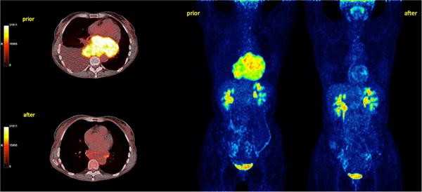 Imaging therapy response of gastrointestinal stromal tumors (GIST) with ...