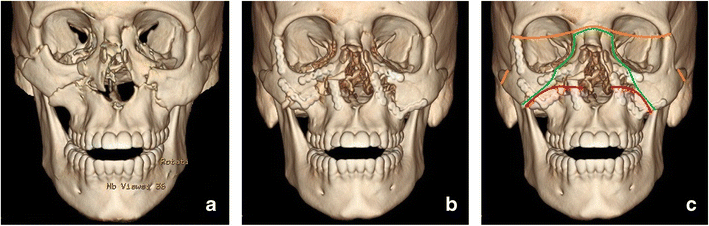 cpt code for closed reduction of zygomatic arch fracture