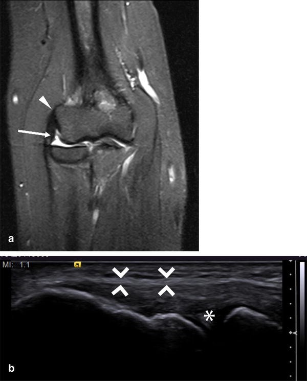 Clinical Examination, Ultrasound and MRI Imaging of The Painful Elbow