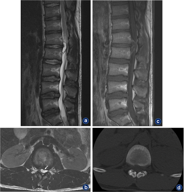 Lumbar Discal Cyst a Rare Cause of Low Back Pain and Sciatica in a