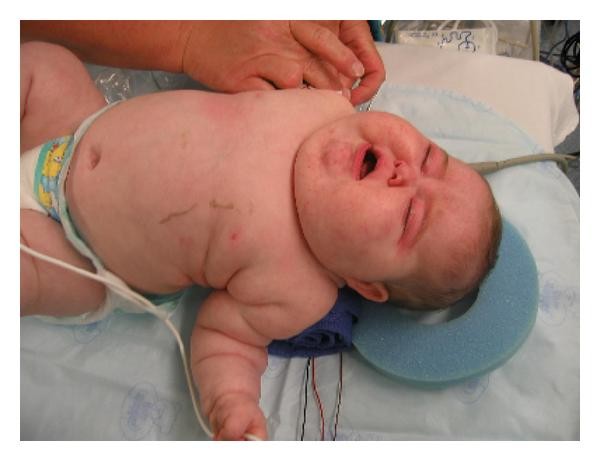 Cushing Syndrome In A 6 Month Old Infant Due To Adrenocortical Tumor International Journal Of