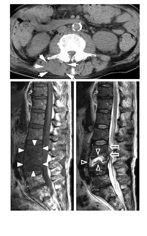 Sternoclavicular joint septic arthritis following paraspinal muscle