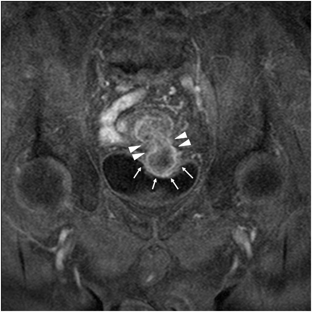 Sigmoid colon cancer arising in a diverticulum of the ... bladder mucosa diagram 