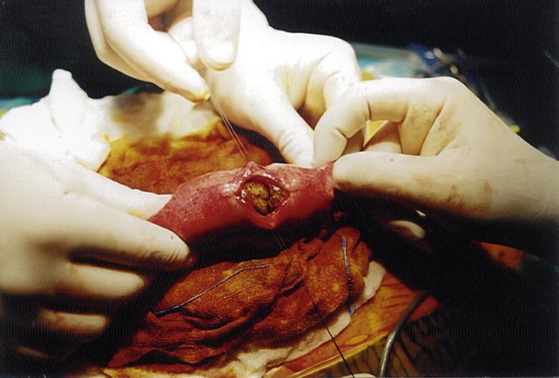 Esophageal and small bowel obstruction by occupational bezoar: report