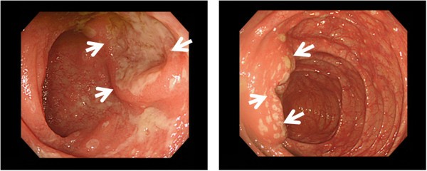 Yersinia pseudotuberculosis enterocolitis mimicking enteropathic γδ T