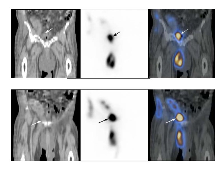 Extraperitoneal urine leak after renal transplantation the role of