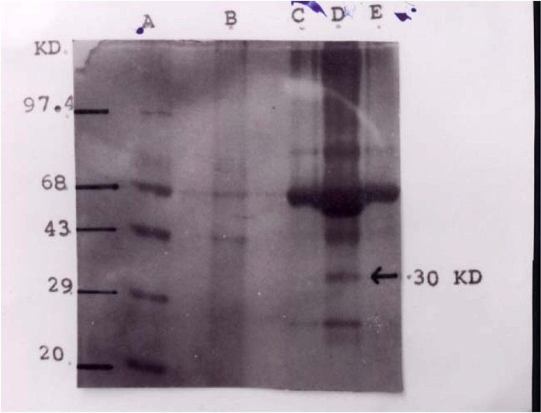 Differential diagnosis of tuberculous meningitis from partiallytreated