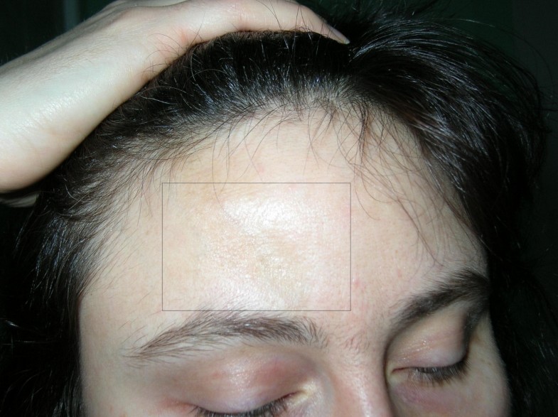 "Scleroderma linearis: hemiatrophia faciei progressiva ...