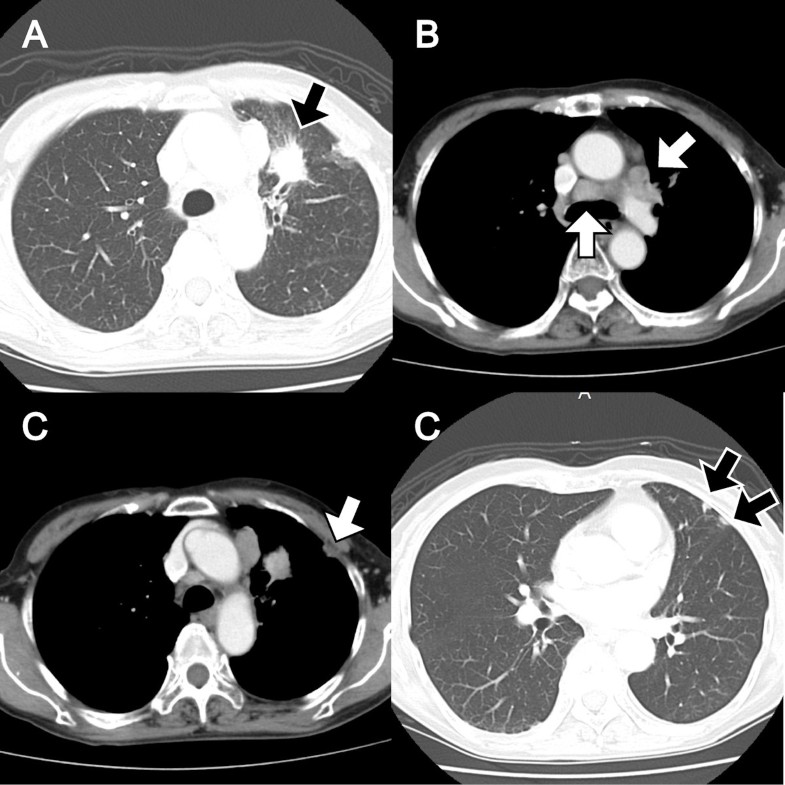 Small-cell lung cancer with a rare epidermal growth factor receptor