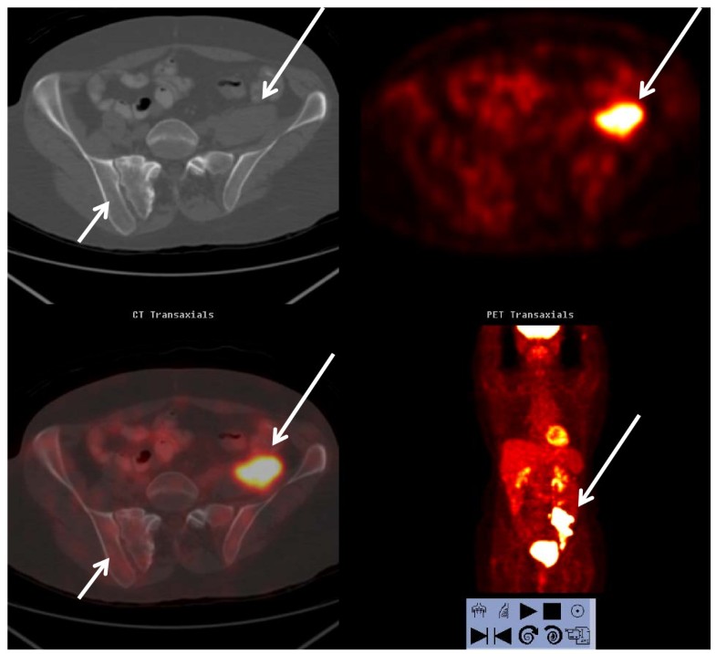 Does colon cancer ever metastasize to bone first? a temporal analysis