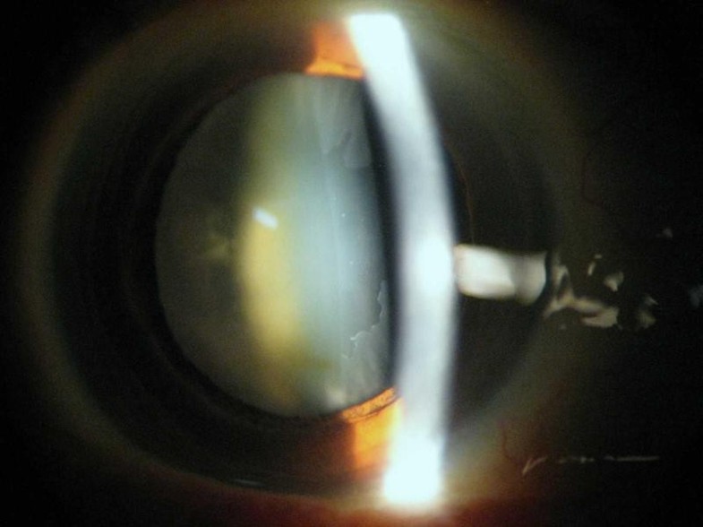 Prevalence of Pseudoexfoliation Syndrome and Pseudoexfoliation