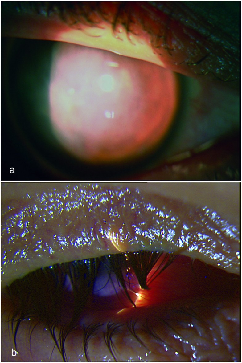 A case of bilateral selfinduced keratoconus in a patient with tourette