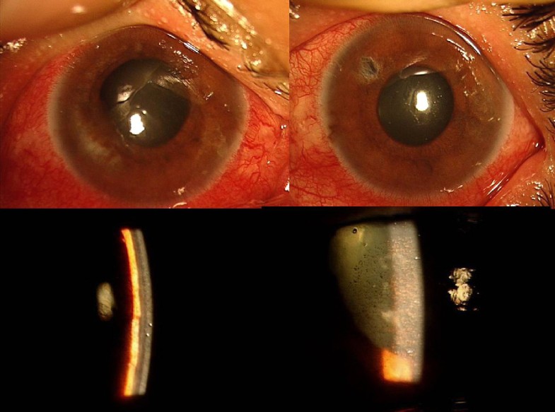 Bilateral acute angle closure as a presentation of isolated