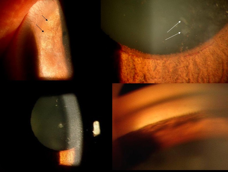 Bilateral acute angle closure as a presentation of isolated