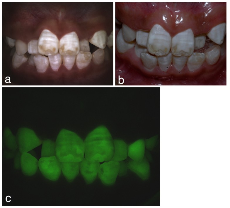 Quantitative Light Fluorescence (QLF) and Polarized White Light (PWL