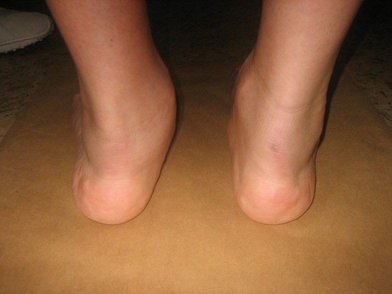 Isolated talonavicular arthrodesis in patients with rheumatoid