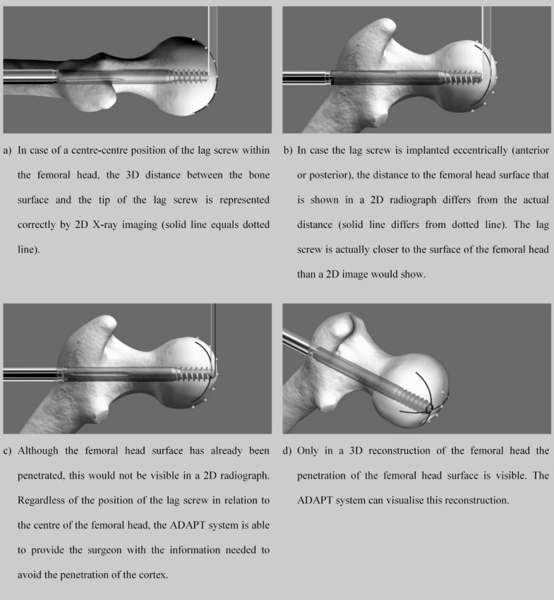 Improved lag screw positioning in the treatment of proximal femur