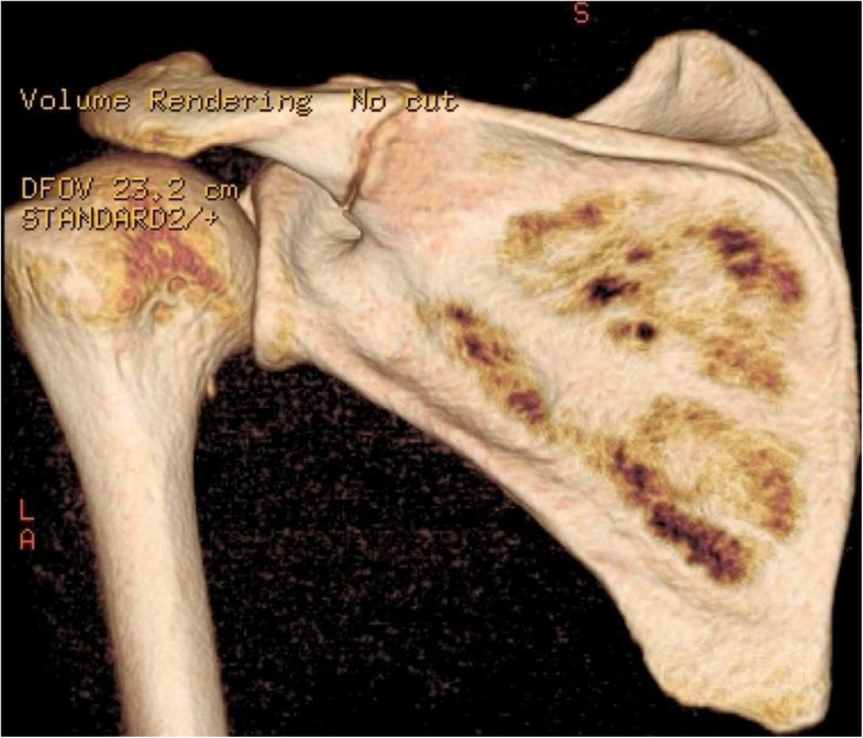 A stress fracture of the base of the acromion: a case report | BMC