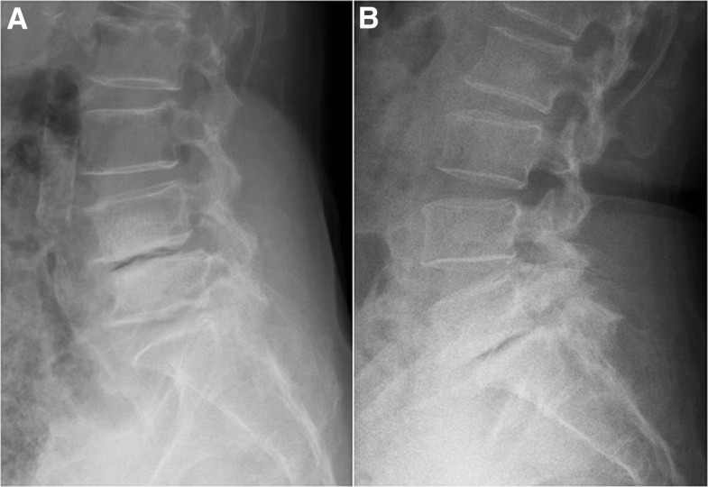 The effects of anterior vacuum disc on surgical of