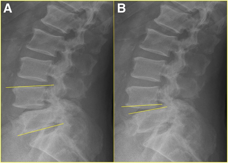 The effects of anterior vacuum disc on surgical of