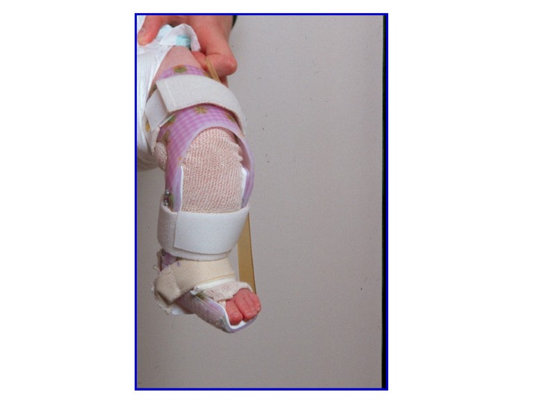Validity and responsiveness of the Clubfoot Assessment Protocol (CAP