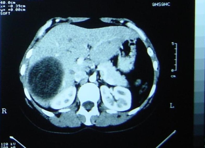 Modified capitonage in partial cystectomy performed for liver hydatid